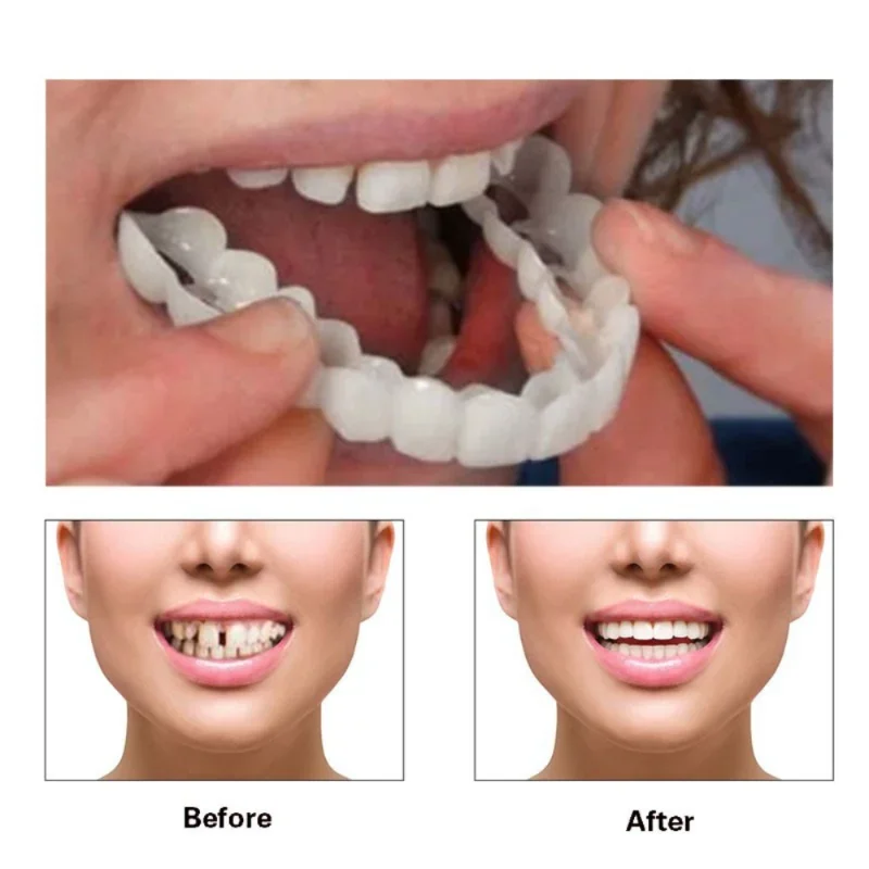 Teeth Whitening Kit - Denture Cover Veneer Snap-on Teeth Kit