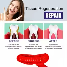 Laser Treatment for Periodonta - огляд і ціна Teeth Whitening Laser Treatment