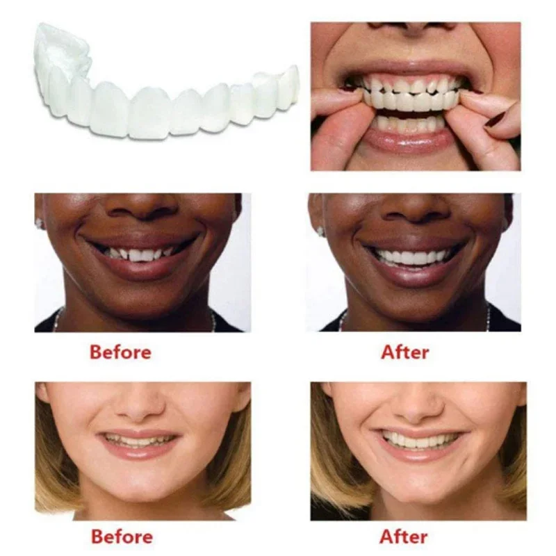 Denture Cover Veneer Snap-on T - огляд і ціна Teeth Whitening Kit
