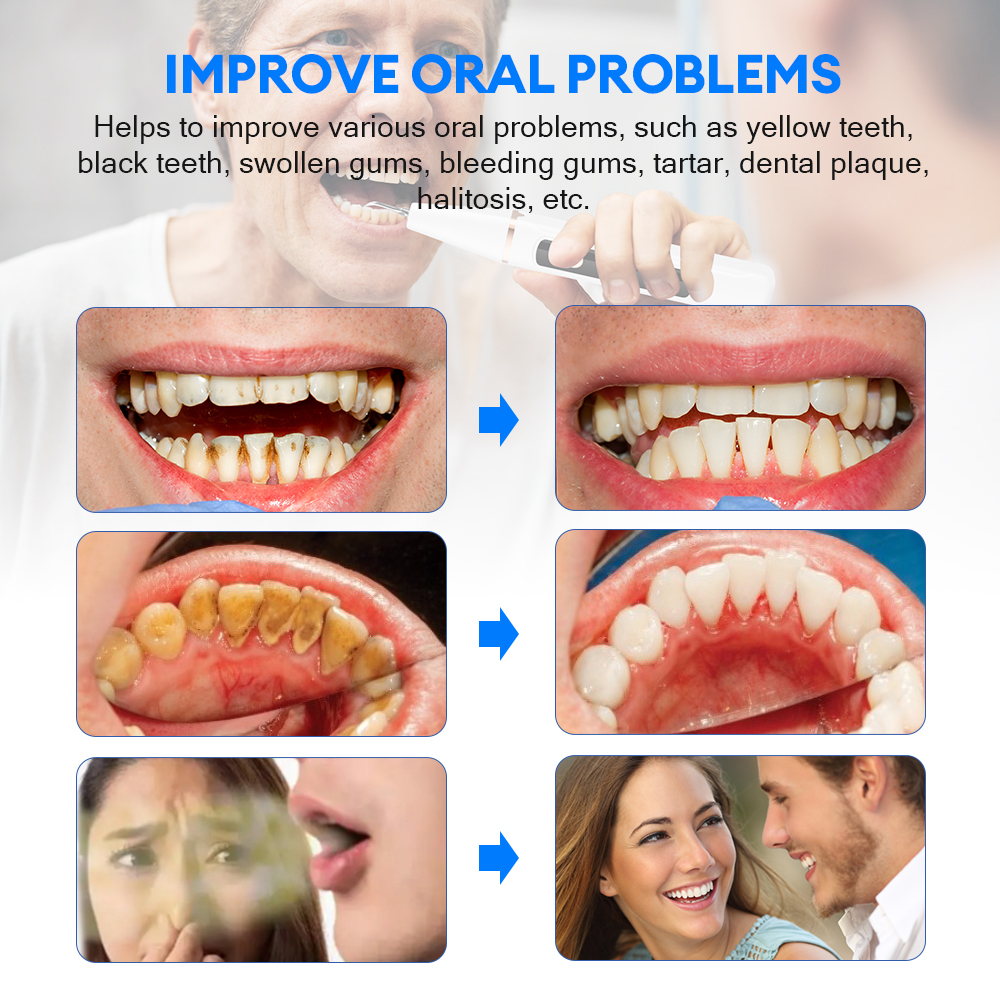 Electric Ultrasonic Dental Sca - огляд і ціна Teeth Whitening Professional