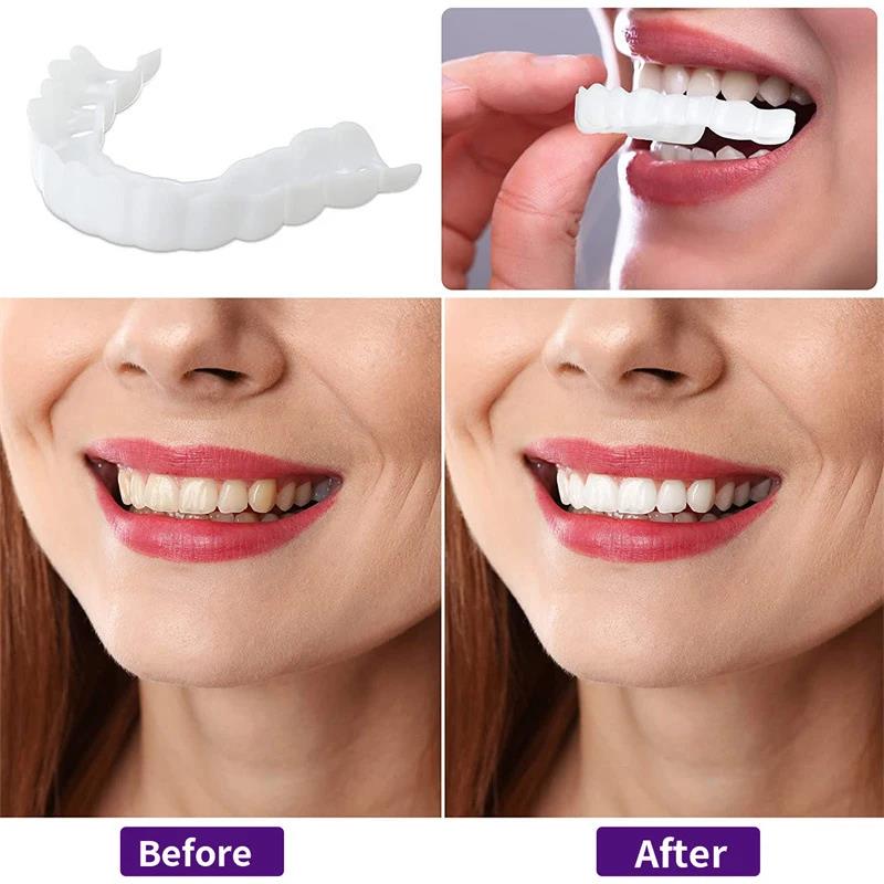 New Defect Repair Teeth Veneer - огляд і ціна Teeth Whitening Uneven