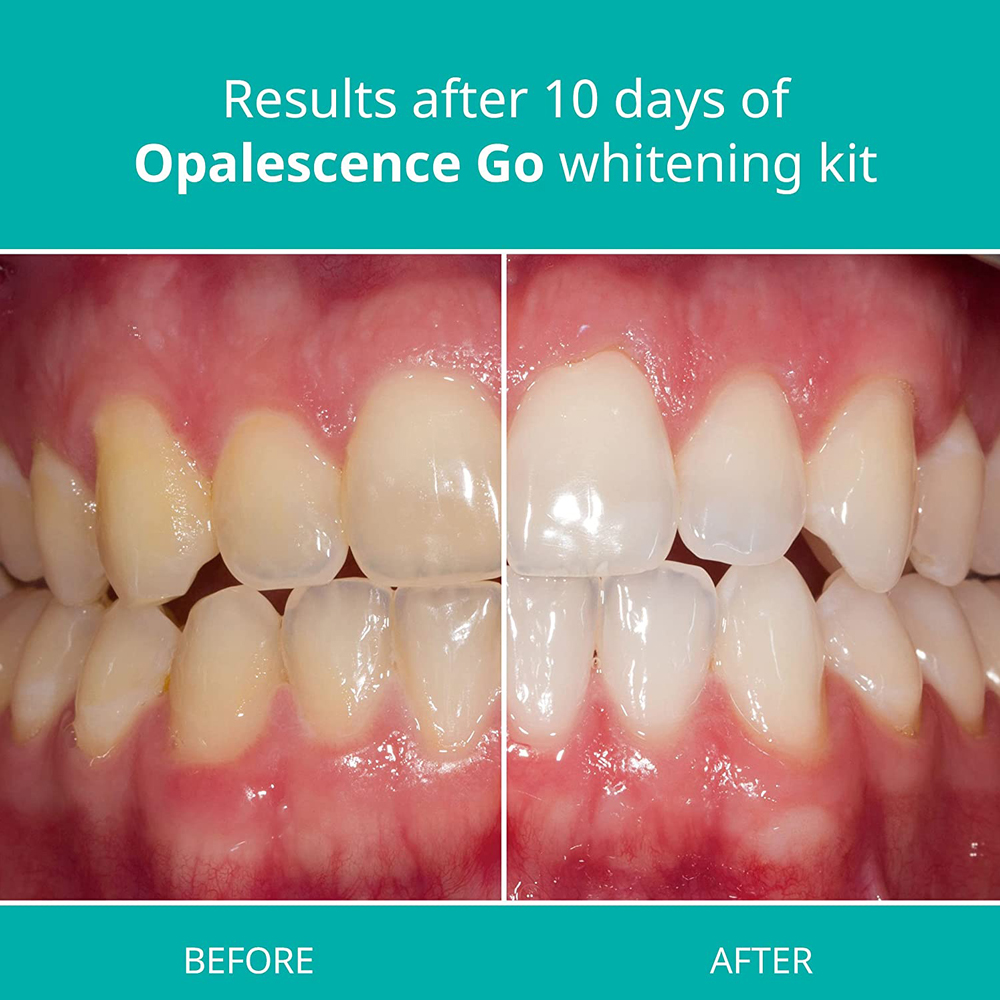 Opalescence Go Teeth Whitening - огляд і ціна Teeth Whitening Opalescence